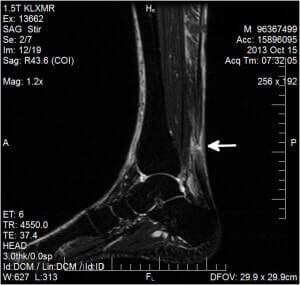 My Achilles Tendon Rupture MRI.