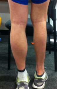 Calf muscle atrophy.